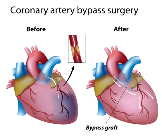 Heart Bypass Surgery Explained In Incredible Pictures