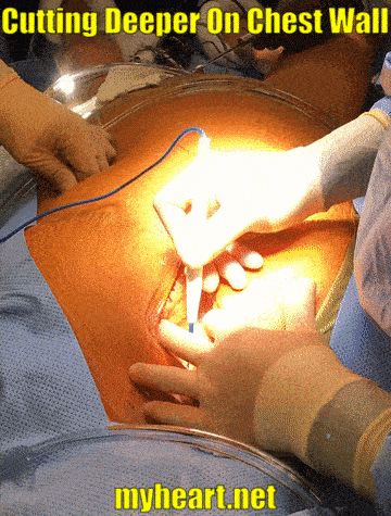 open heart surgery cutting deeper on chest wall