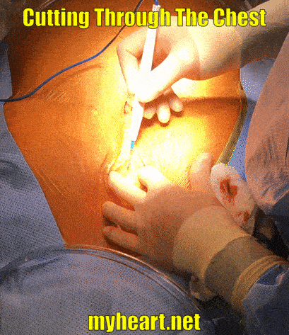 open heart surgery cutting through the chest
