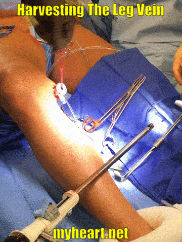 open heart surgery harvesting the leg vein