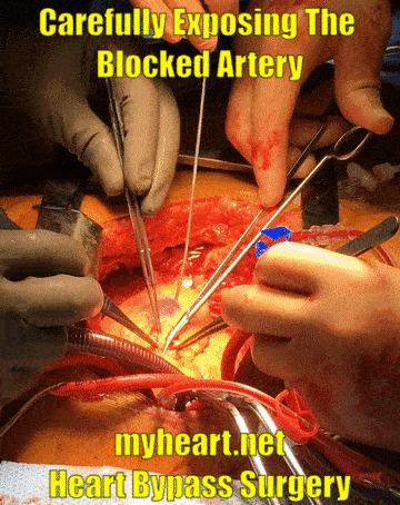 heart bypass surgery carefully exposing the blocked artery