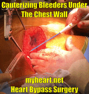 heart bypass surgery cauterizing bleeders under the chest wall