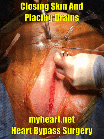heart bypass surgery closing skin and placing drains