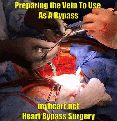 heart bypass surgery preparing the vein to use as a bypass