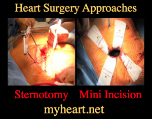 sternotomy vs. mini incision open heart surgery