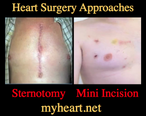 open heart surgery approaches scars