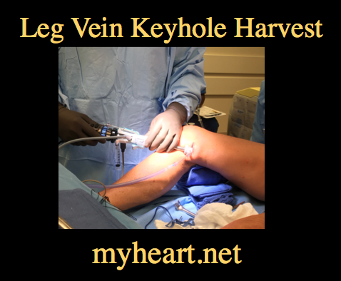 heat bypass surgery keyhole leg vein harvest