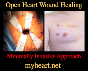 open heart wound healing minimally invasive