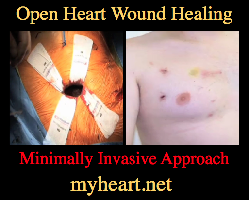 Open Heart Surgery – Incredible Picture Guide! • MyHeart