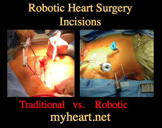 robotic mitral valve replacement