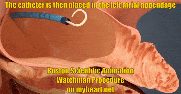 watchman-procedure-4-catheter-placed-in-appendage