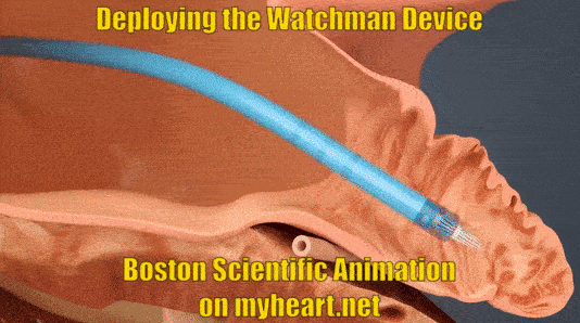 Watchman Device – Explained and FAQ's Answered by a Cardiologist • MyHeart