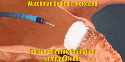 watchman-procedure-7-releasing-device