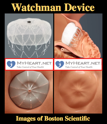 Watchman Device – Explained and FAQ’s Answered by a Cardiologist • MyHeart