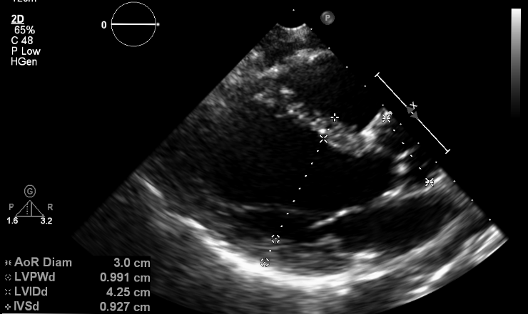 echocardiogram heart ultrasound vs