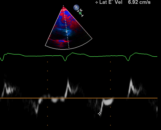 What Does An Echocardiogram Show Tissue Doppler