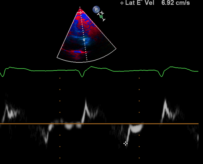 abnormal echocardiogram results