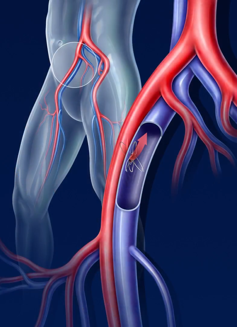 Treatment Of High Blood Pressure When Medicines Don T Work Myheart