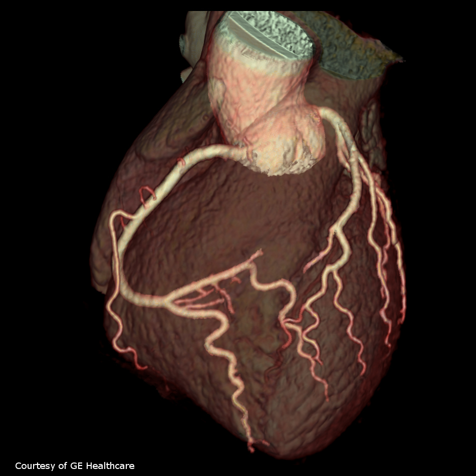 Contrast Media with and without Calcium for Cardioangiography in