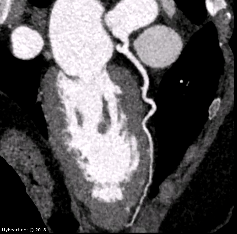 What Does A Cardiac CT Scan Show or Detect and When Do You Need It