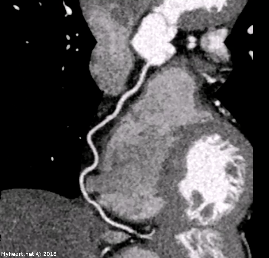 memorial sloan kettering mesothelioma