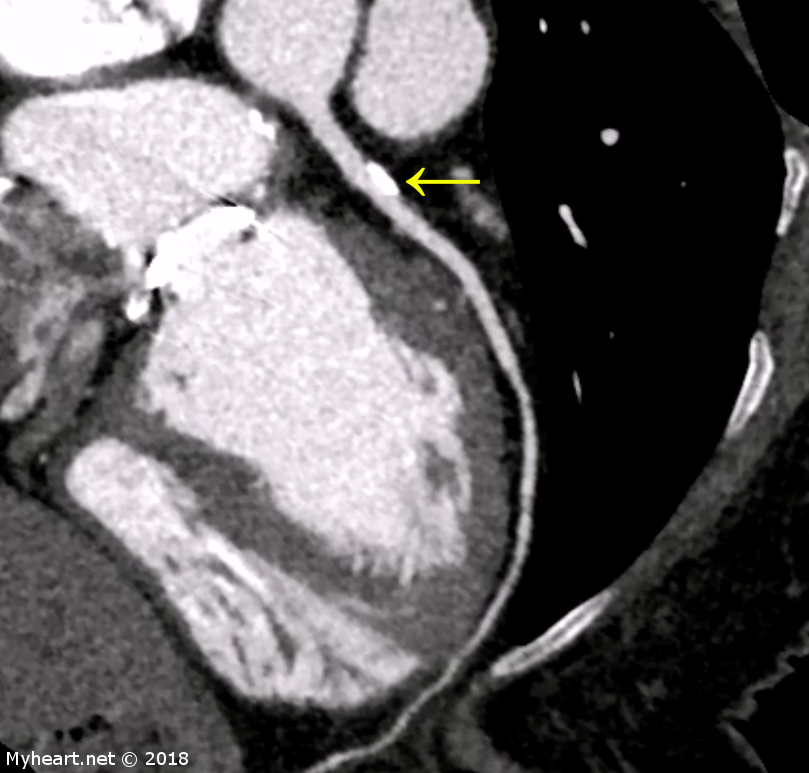 cardiac ct scan