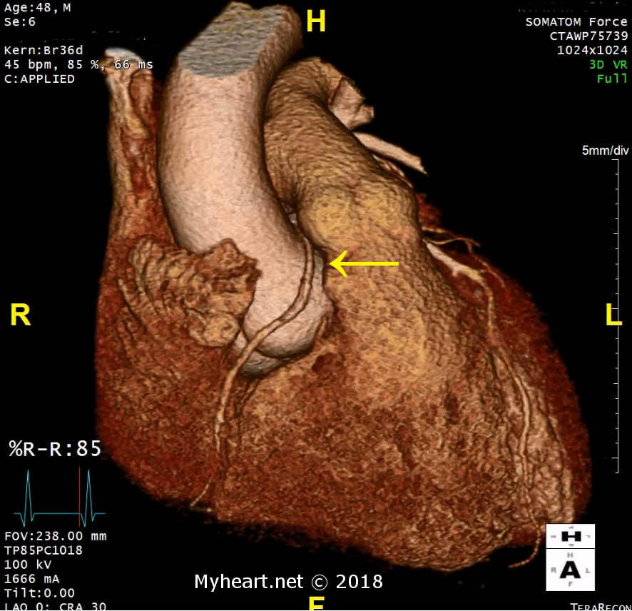 heart test valvular MyHeart CARDIAC â€¢ WHAT SHOW? CT DOES