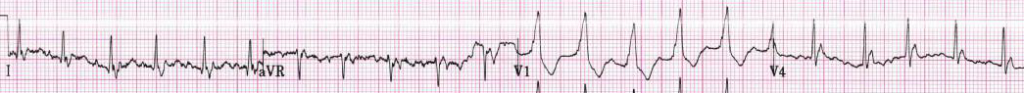 Atrial fibrillation at a rate of 130 bpm.