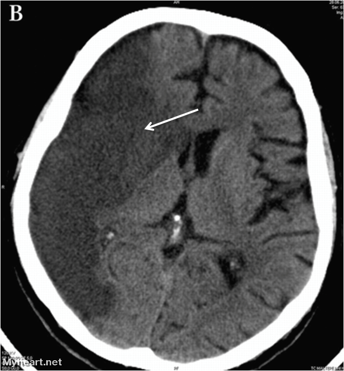 Stroke Ct Scan