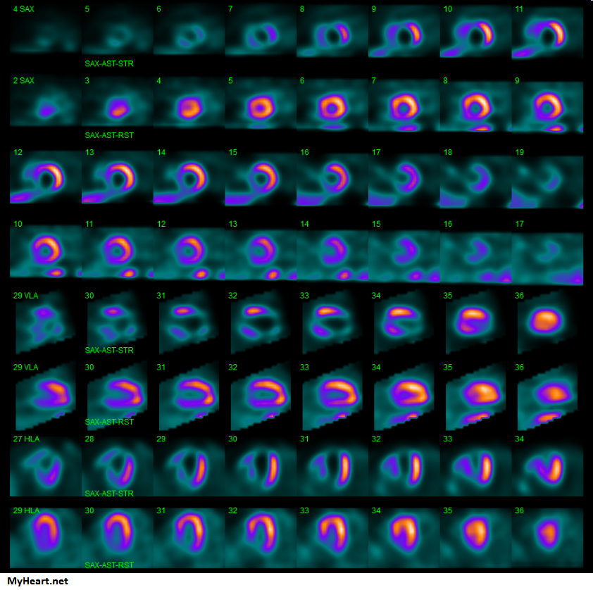 Abnormal tracer distribution due to blockage shown by nuclear stress test.