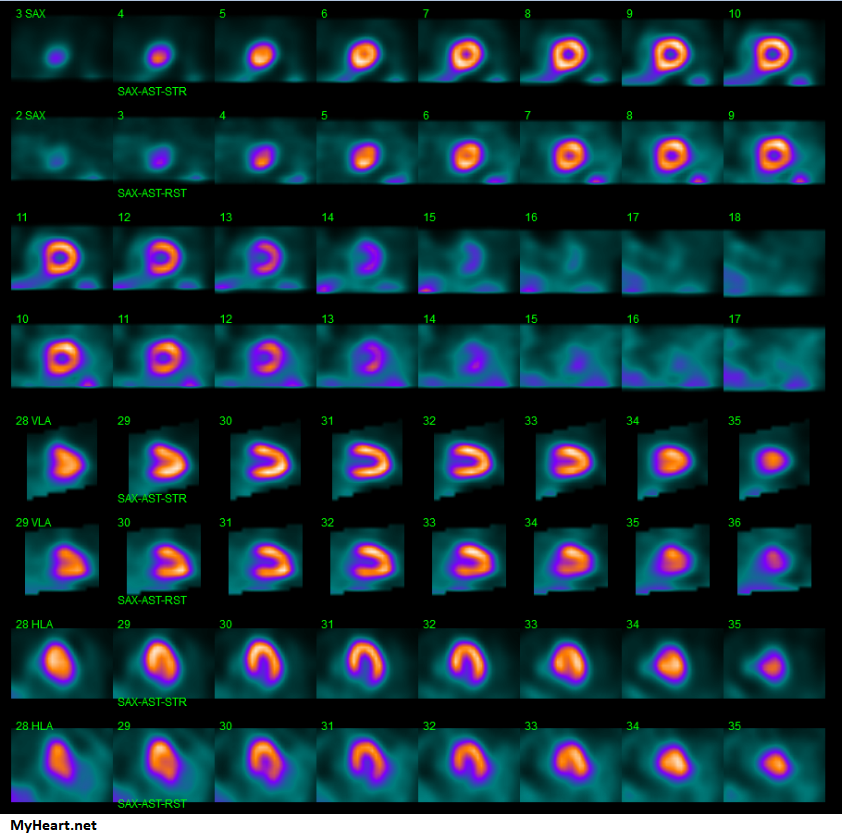 Normal blood flow shown by nuclear stress test.