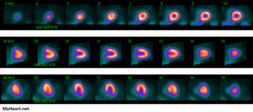 Short Axis, Vertical Long Axis, Horizontal Long Axis slices of a normal heart.