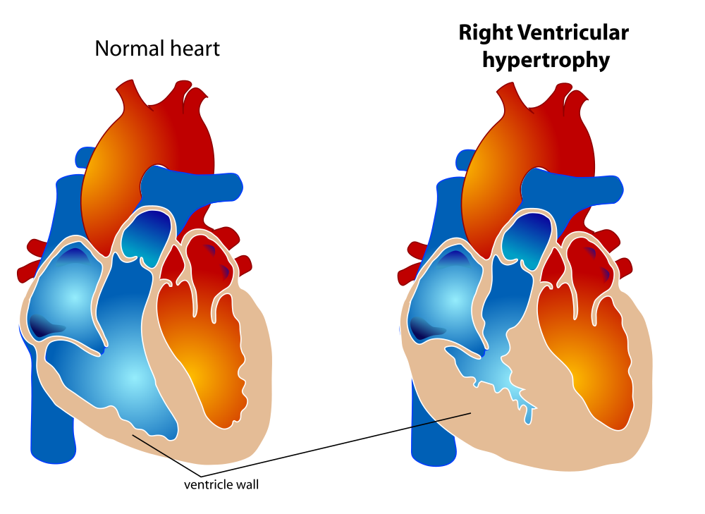 Diagram showing a normal heart compared to one with right ventricular hypertrophy.