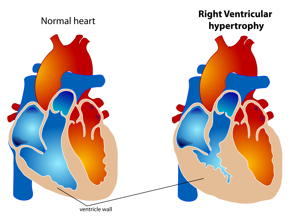 Cardiomegaly Explained by a Cardiologist • MyHeart