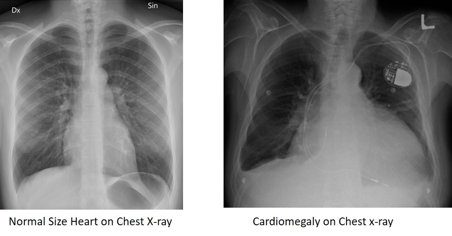 Mild Lvh Icd 10