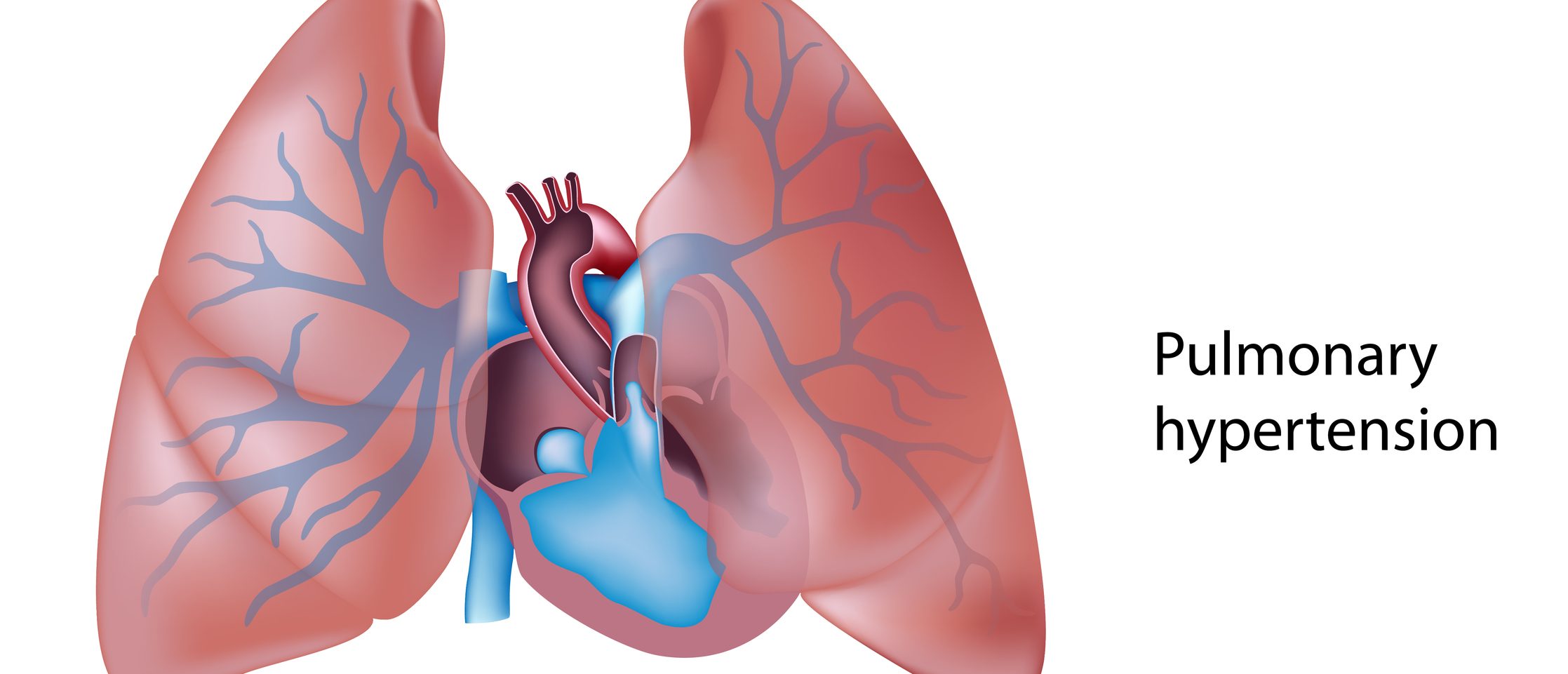 Pulmonary Hypertension Due To Left Heart Disease An Update